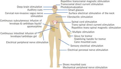 Therapeutic Devices for Motor Symptoms in Parkinson’s Disease: Current Progress and a Systematic Review of Recent Randomized Controlled Trials